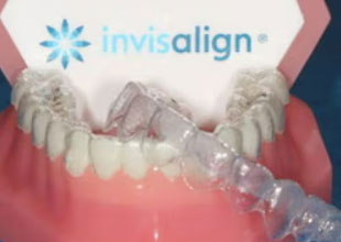 Invisalign