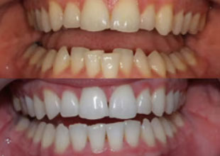 Teeth Whitening